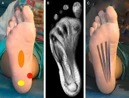 Plantar fasciitis