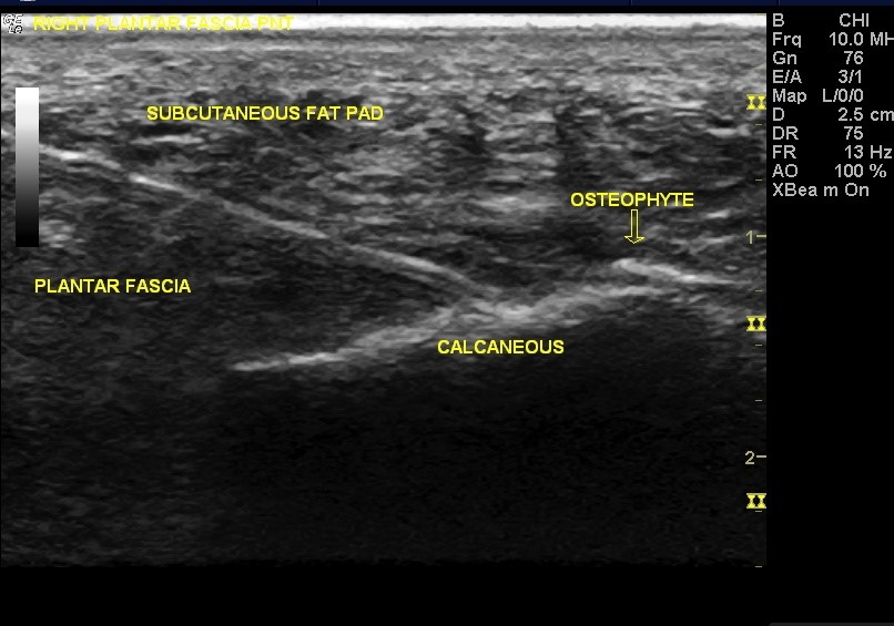 Plantar fasciitis2