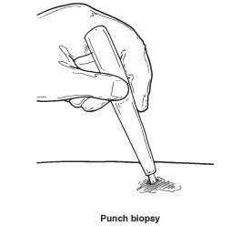 Soft Tissue Biopsy2