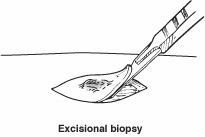 Soft Tissue Biopsy3