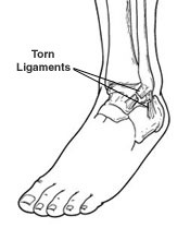 ankle sprain2