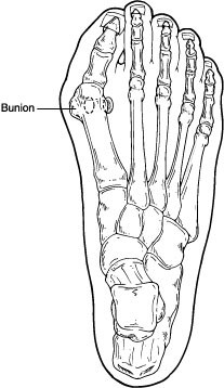 bunionectomy