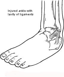 chronic ankle instability2