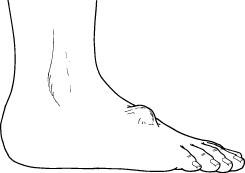 cyst