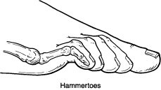 hammertoe2