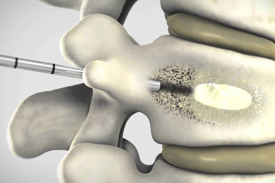ISASS Reaffirms support for vertebral augmentation for VCFs