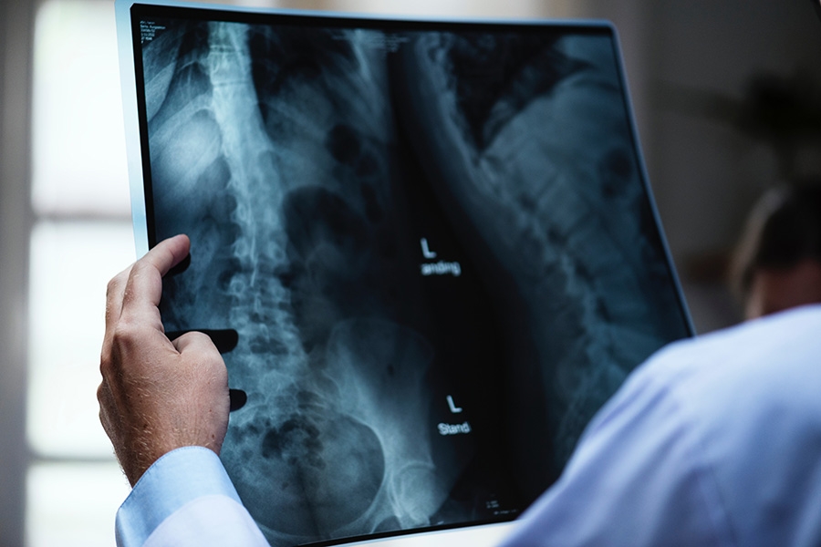 Spine surgery society makes recommendations for bone graft substitutes