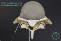 Decompression of Lumbar Spinal Stenosis Using iO-Flex® MBS Device