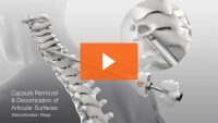 Patients Achieve Significant Relief with Minimally Invasive PCF